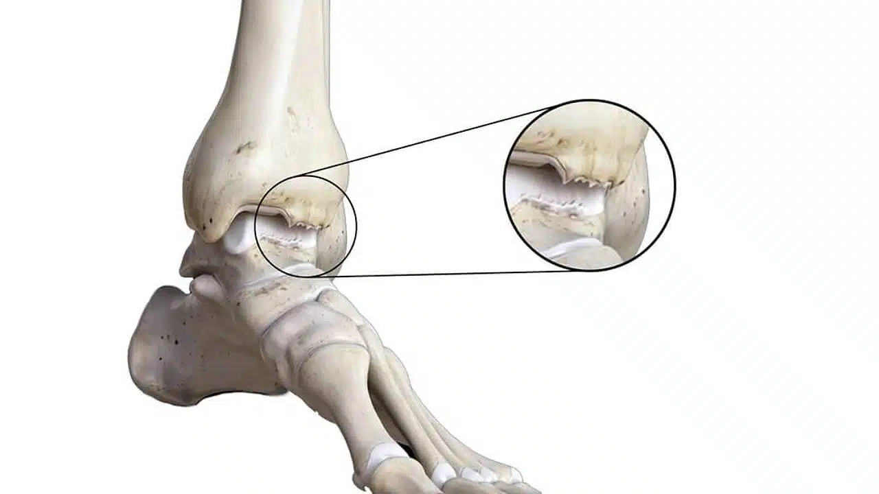 Foot And Ankle Arthritis Diagram With Ligaments