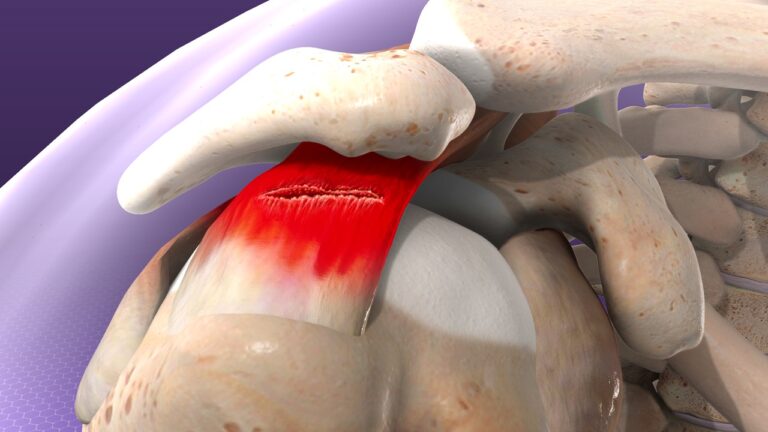 Understanding Rotator Cuff Injuries: Causes, Symptoms, And Treatment Options